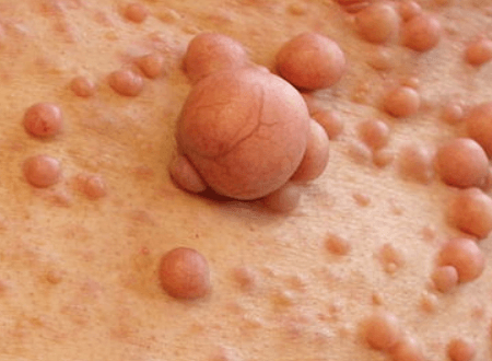 What Is NF: Clear Explanation of Neurofibromatosis and Its Types