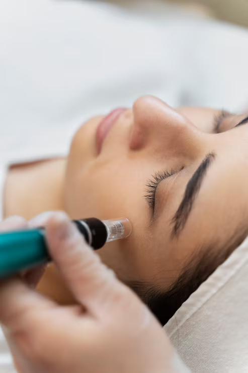 Looking for Microneedling Near Me in London? Here's How to Compare Clinics Beyond Before-and-After Photos