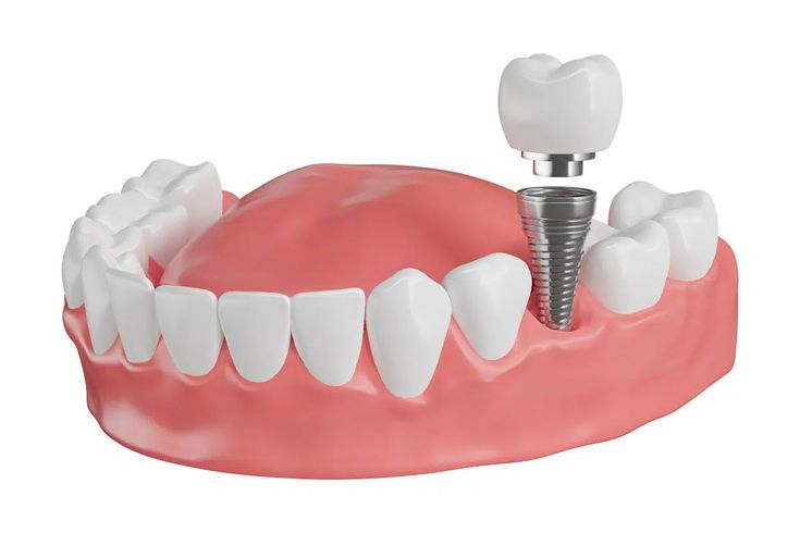 Is It Possible To Replace Missing Teeth With Dental Implants Forever?