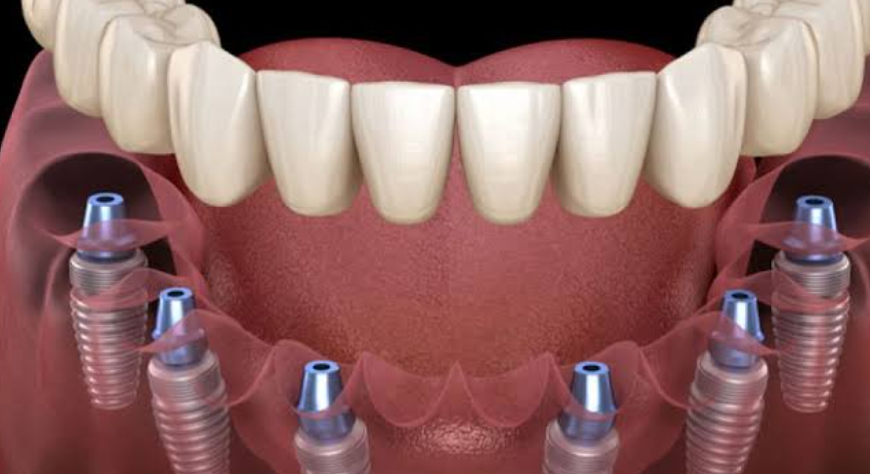 How General And Implant Dentistry Work Together For Full Mouth Rehab