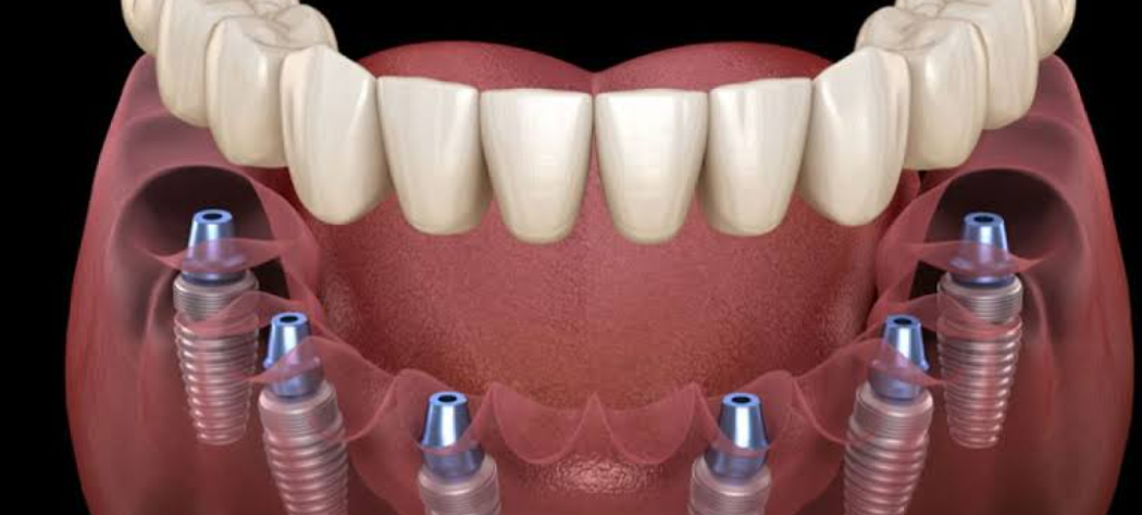 How General And Implant Dentistry Work Together For Full Mouth Rehab