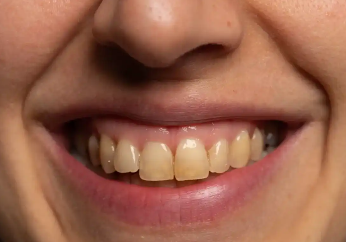 Why Uneven Tooth Staining May Point To Differences In Cleaning